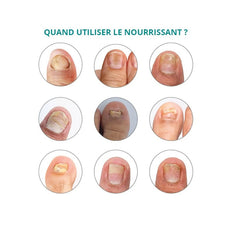 Treatment for Striated, dry, brittle nails - 30ml - Nourishing - Application with pipette - Poderm Professional - My Podologie