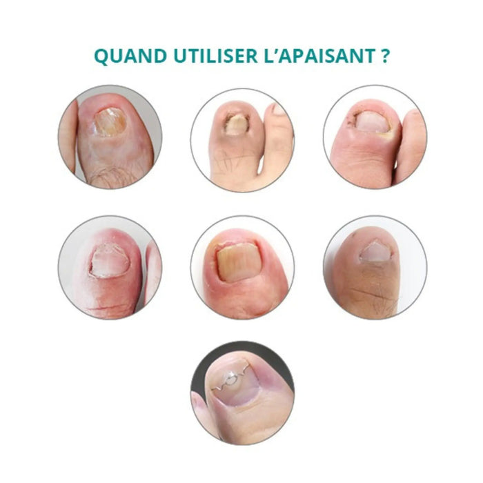 Ingrown, encrusted nail treatment - 30ml - Soothing - Application with pipette - Poderm Professional - My Podologie