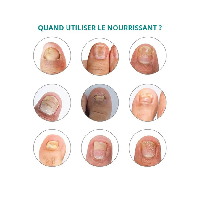 Treatment for Striated, dry, brittle nails - 30ml - Nourishing - Application with pipette - Poderm Professional - My Podologie
